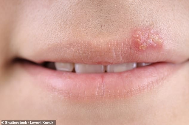Những dấu hiệu “lạ” mà cơ thể đang cố nói với bạn - 5
Mụn trên môi là một biểu hiện của một nhiễm vi-rút thể ẩn có thể bùng phát khi hệ thống miễn dịch bị tổn hại