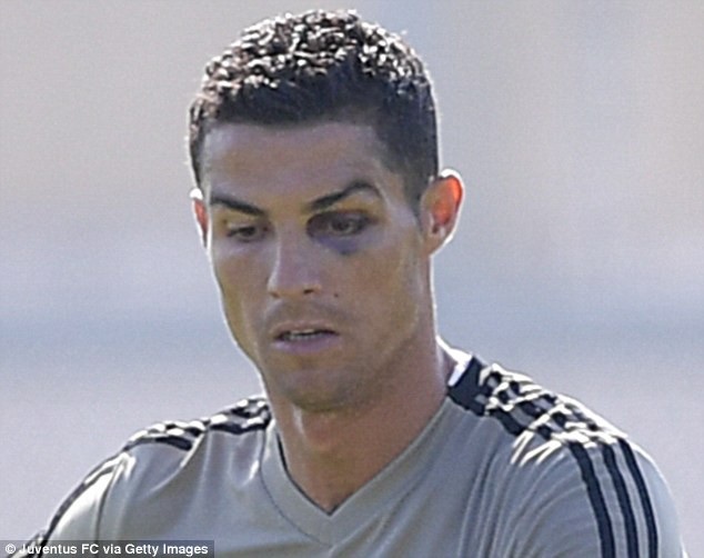 C.Ronaldo tập luyện với một bên mắt bầm tím - 2 C.Ronaldo tập luyện với một bên mắt bầm tím - 2