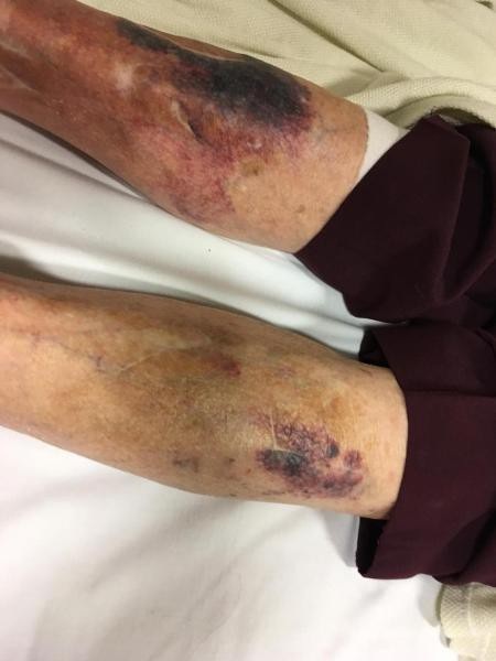 Cụ bà bị thương tích đầy mình