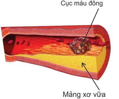 Mổ lấy được cục máu đông gây đột quỵ dài gần 10cm - 2 Cục máu đông gây chít hẹp lòng mạch, tắc mạch