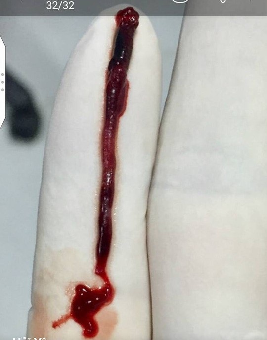 Mổ lấy được cục máu đông gây đột quỵ dài gần 10cm - 1
Cục máu đông gây đột quỵ dài gần 10cm chưa từng có