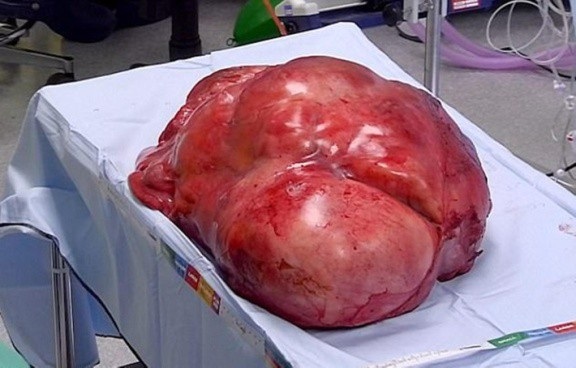 Cận cảnh khối u nặng 3 stone (hơn 19 kg) trong dạ dày của cụ Jasmine