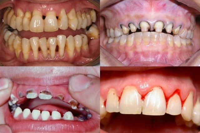 Hậu quả của việc răng không được bọc sứ ngay nhưng vẫn làm ❗◊