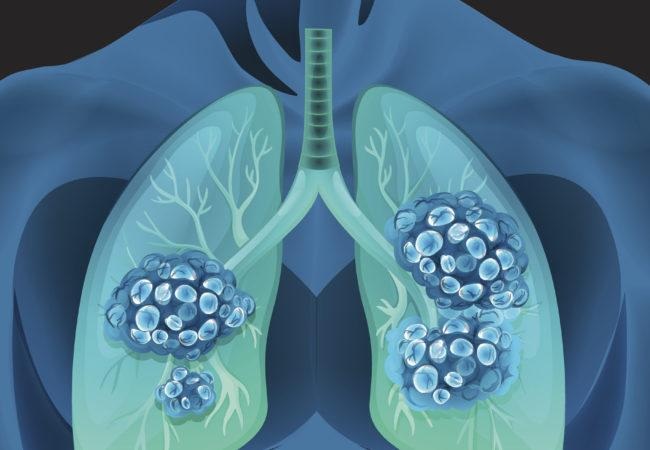 Sản phẩm Tumolung – Bước đột phá mới trong việc phòng ngừa và hỗ trợ điều trị u phổi - 2