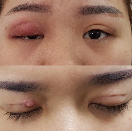 Kim khâu gãy nằm trong mắt lúc nhấn mí - Ảnh 2. Kim khâu gãy nằm trong mắt lúc nhấn mí - Ảnh 2.