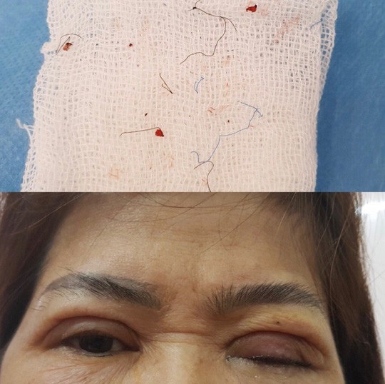 Kim khâu gãy nằm trong mắt lúc nhấn mí - Ảnh 3. Kim khâu gãy nằm trong mắt lúc nhấn mí - Ảnh 3.