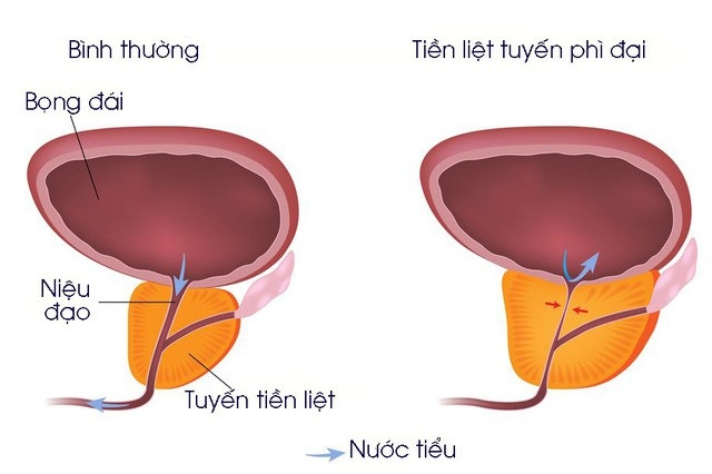 Khác Phì đại tiền liệt tuyến có đáng sợ như bạn nghĩ?