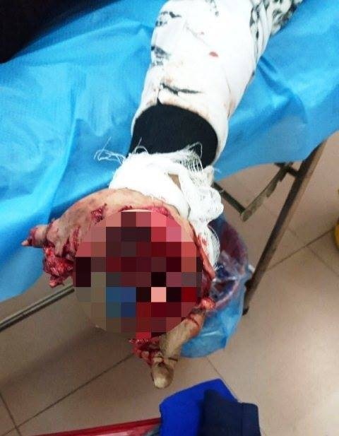 Dùng điện thoại khi đang sạc, nam thanh niên bị nổ tung bàn tay - Ảnh 1. Dùng điện thoại khi đang sạc, nam thanh niên bị nổ tung bàn tay - Ảnh 1.