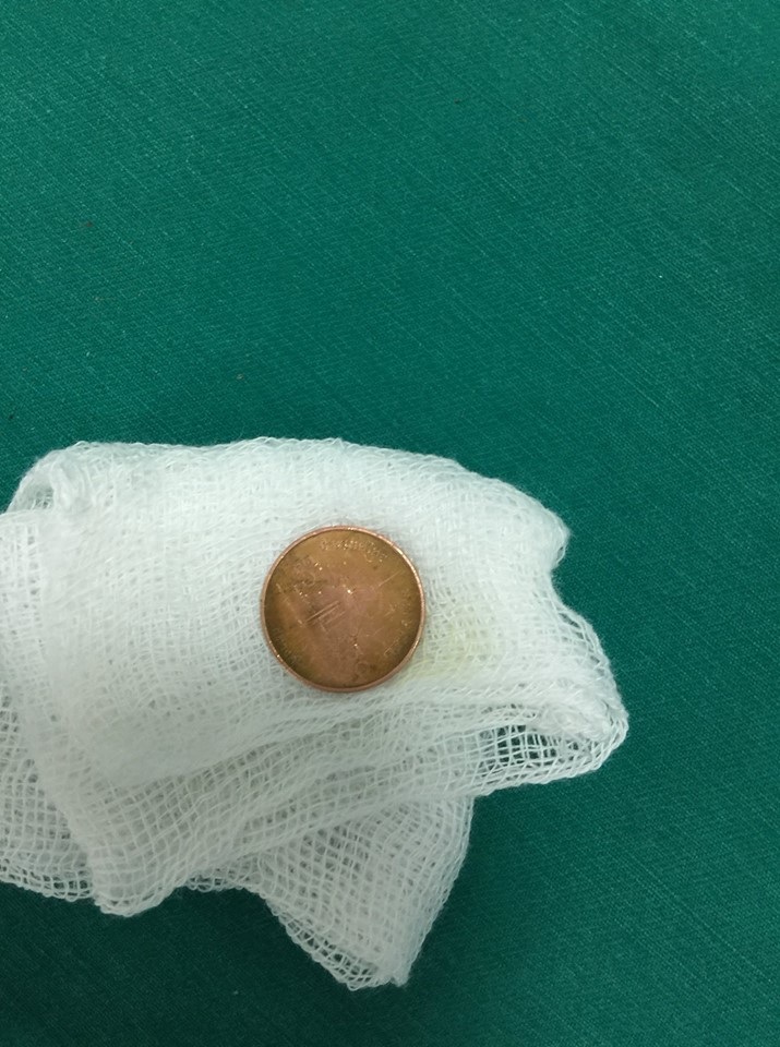 Bé gái ngậm đồng xu, trôi tọt vào họng khi đang chơi đùa - Ảnh 2. Bé gái ngậm đồng xu, trôi tọt vào họng khi đang chơi đùa - Ảnh 2.