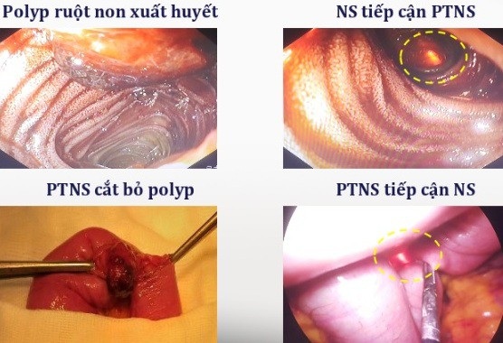Bệnh nhân mất gần 3 lít máu đường tiêu hóa vì không tìm ra vị trí chảy máu - Ảnh 3. Bệnh nhân mất gần 3 lít máu đường tiêu hóa vì không tìm ra vị trí chảy máu - Ảnh 3.