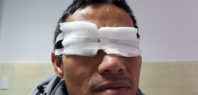 Một nam giới đối mặt với nguy cơ mù mắt phải vì chơi pháo hoa dịp lễ tết - Ảnh 1. Một nam giới đối mặt với nguy cơ mù mắt phải vì chơi pháo hoa dịp lễ tết - Ảnh 1.
