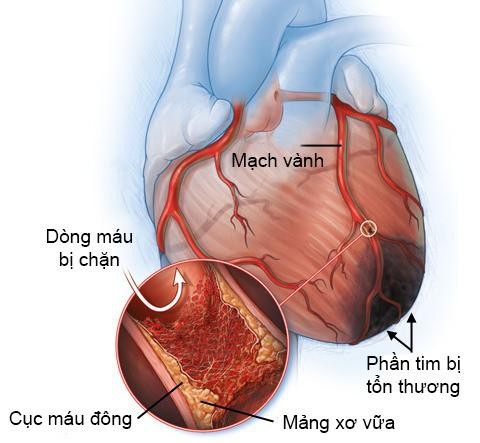 Nguy cơ nhồi máu cơ tim do chủ quan với máu nhiễm mỡ - Ảnh 1. Nguy cơ nhồi máu cơ tim do chủ quan với máu nhiễm mỡ - Ảnh 1.