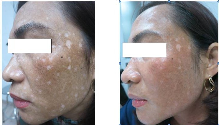 Hoảng hồn gương mặt lốm đốm nốt trắng, nốt đen vì đắp lá trầu làm đẹp - Ảnh 1. Hoảng hồn gương mặt lốm đốm nốt trắng, nốt đen vì đắp lá trầu làm đẹp - Ảnh 1.