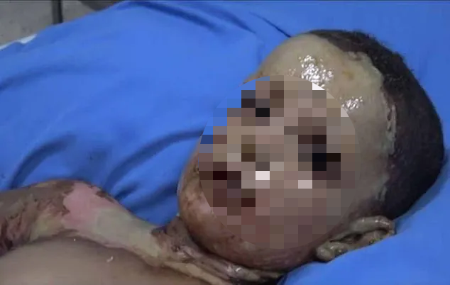 Những đứa trẻ Syria bị trúng bom trong chiến sự dữ dội của Thổ Nhĩ Kỳ