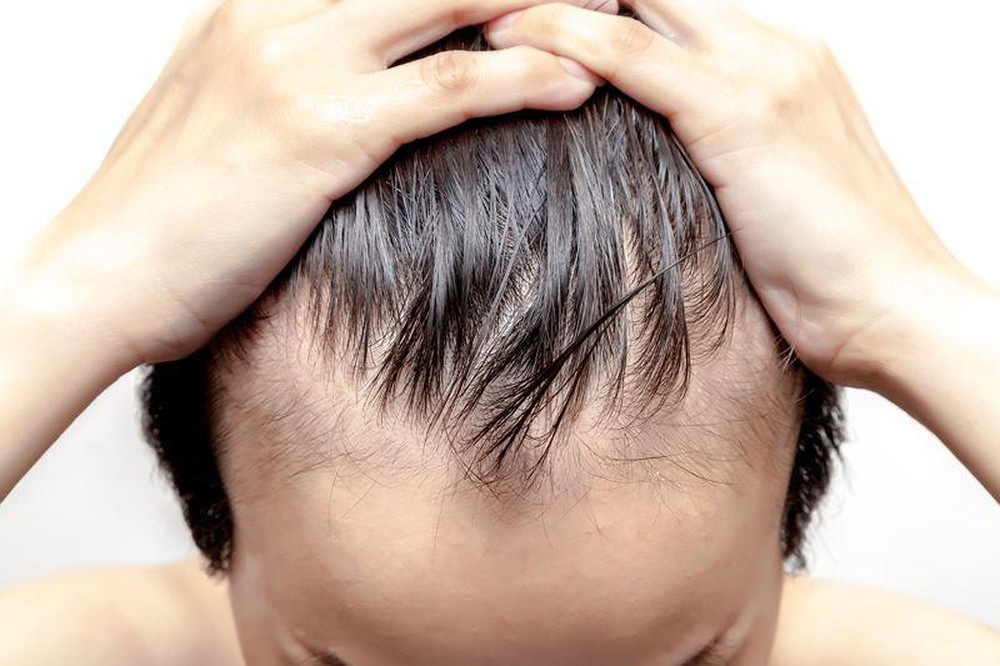 Top 8 kiểu tóc dành cho người bị hói đầu  VIỆN CẤY TÓC TỰ THÂN NEWHAIR BY  KHƠ THỊ