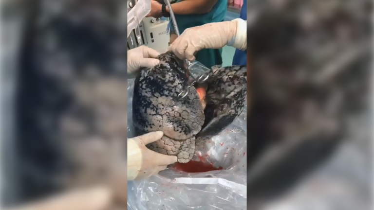 “Sốc” video phổi đen như than của người hút thuốc