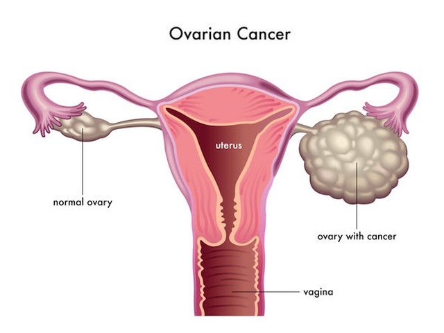 Vì sao ung thư buồng trứng khó phát hiện? - 1