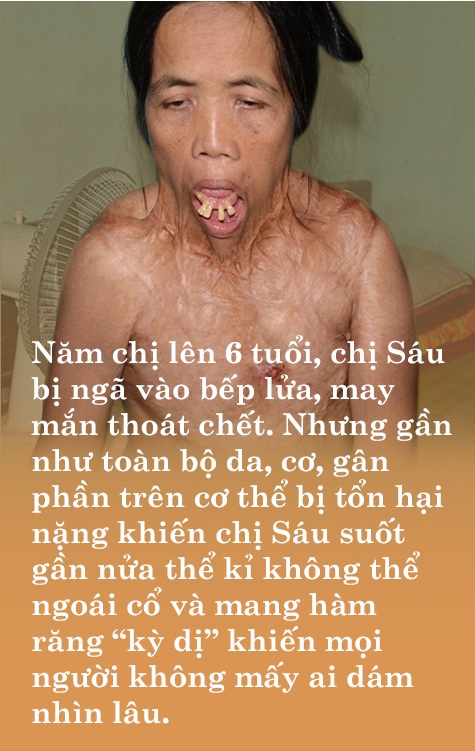 Người đàn bà nửa thế kỉ mang hàm răng kì dị: Tôi nghĩ cuộc đời đã bỏ đi - 7 Người đàn bà nửa thế kỉ mang hàm răng kì dị: Tôi nghĩ cuộc đời đã bỏ đi - 7