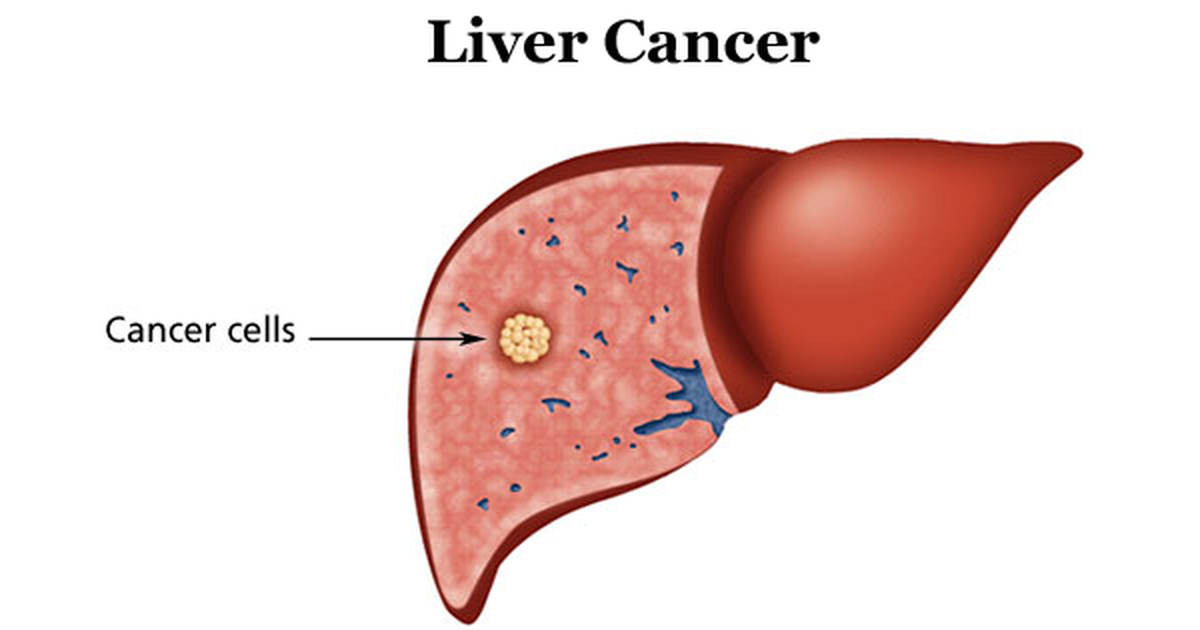 Bạn nên tầm soát ung thư gan khi thấy những dấu hiệu này - 1