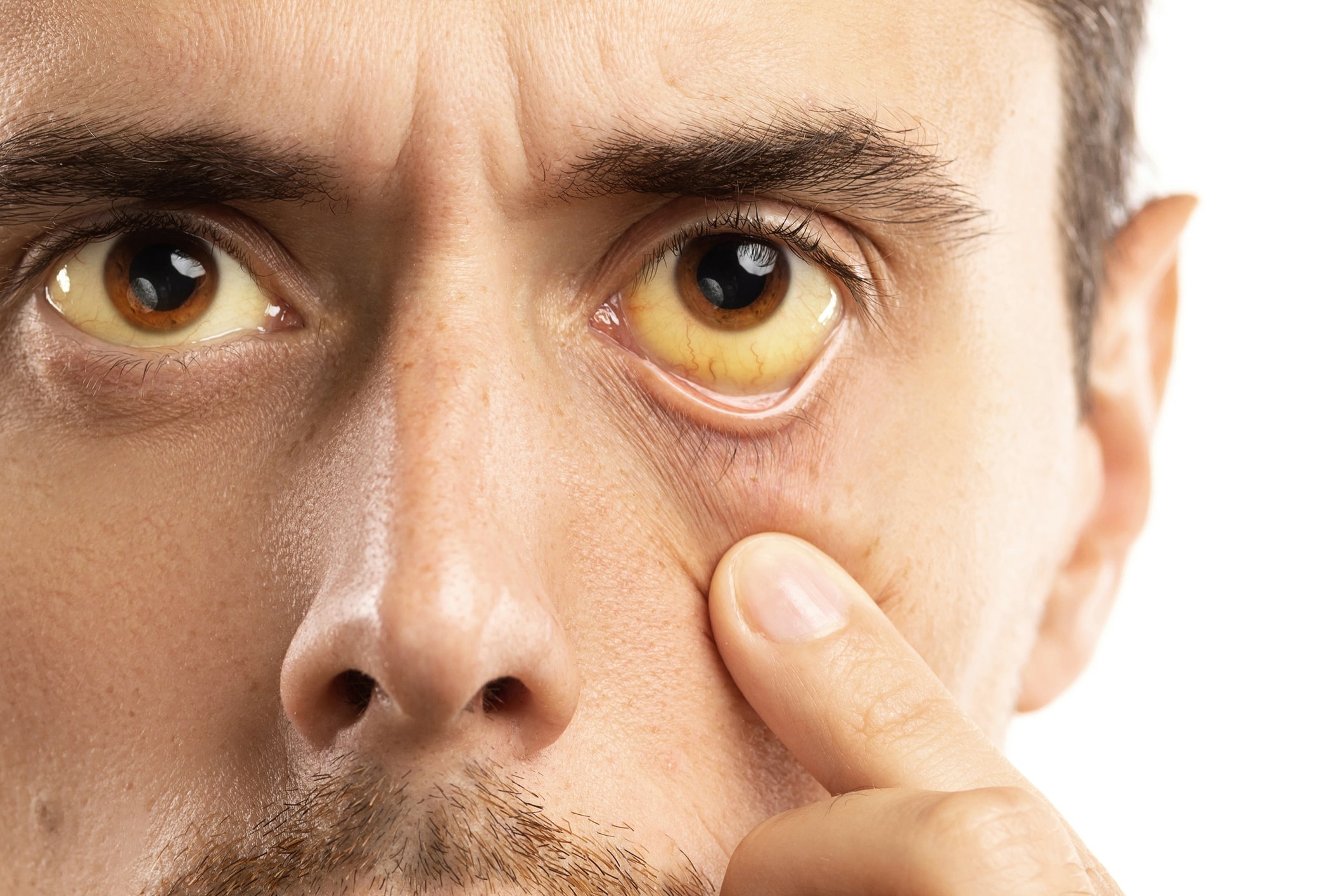 Vàng da, vàng mắt: Không chỉ là dấu hiệu của bệnh gan - 2