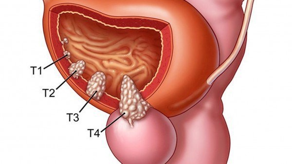 Ung thư bàng quang dễ di căn đến những bộ phận này? - 1