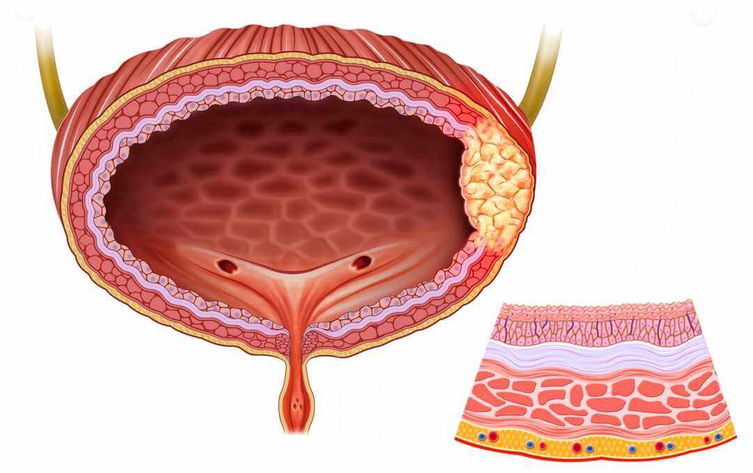 6 dấu hiệu sớm của ung thư bàng quang - 1