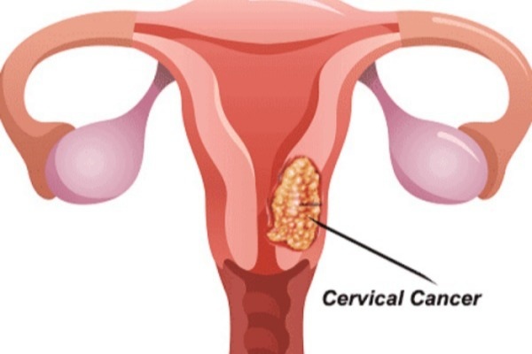 Ung thư cổ tử cung giai đoạn 2 được điều trị bằng cách nào? - 1