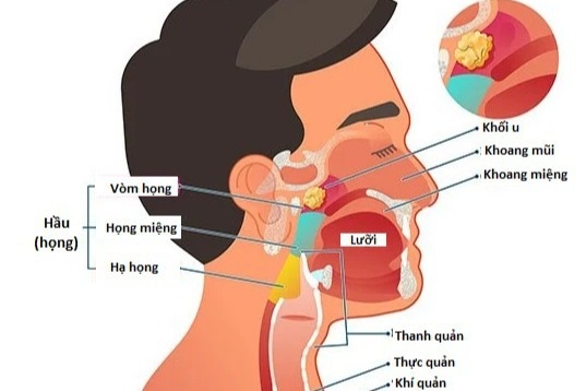 Triệu chứng của ung thư vòm họng là gì? - 1
