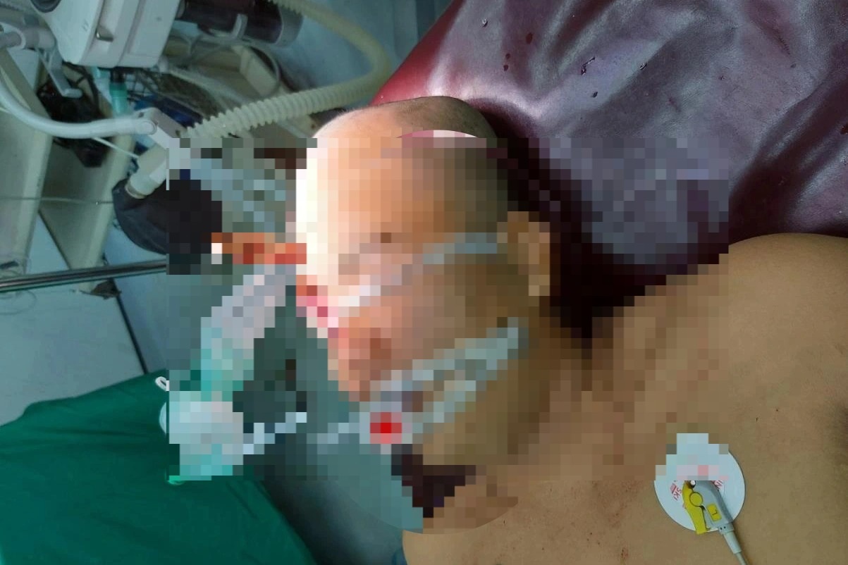 Cưa cây, nam thanh niên bị gỗ văng găm lún sọ vào não - 1 Cưa cây, nam thanh niên bị gỗ văng găm lún sọ vào não - 1