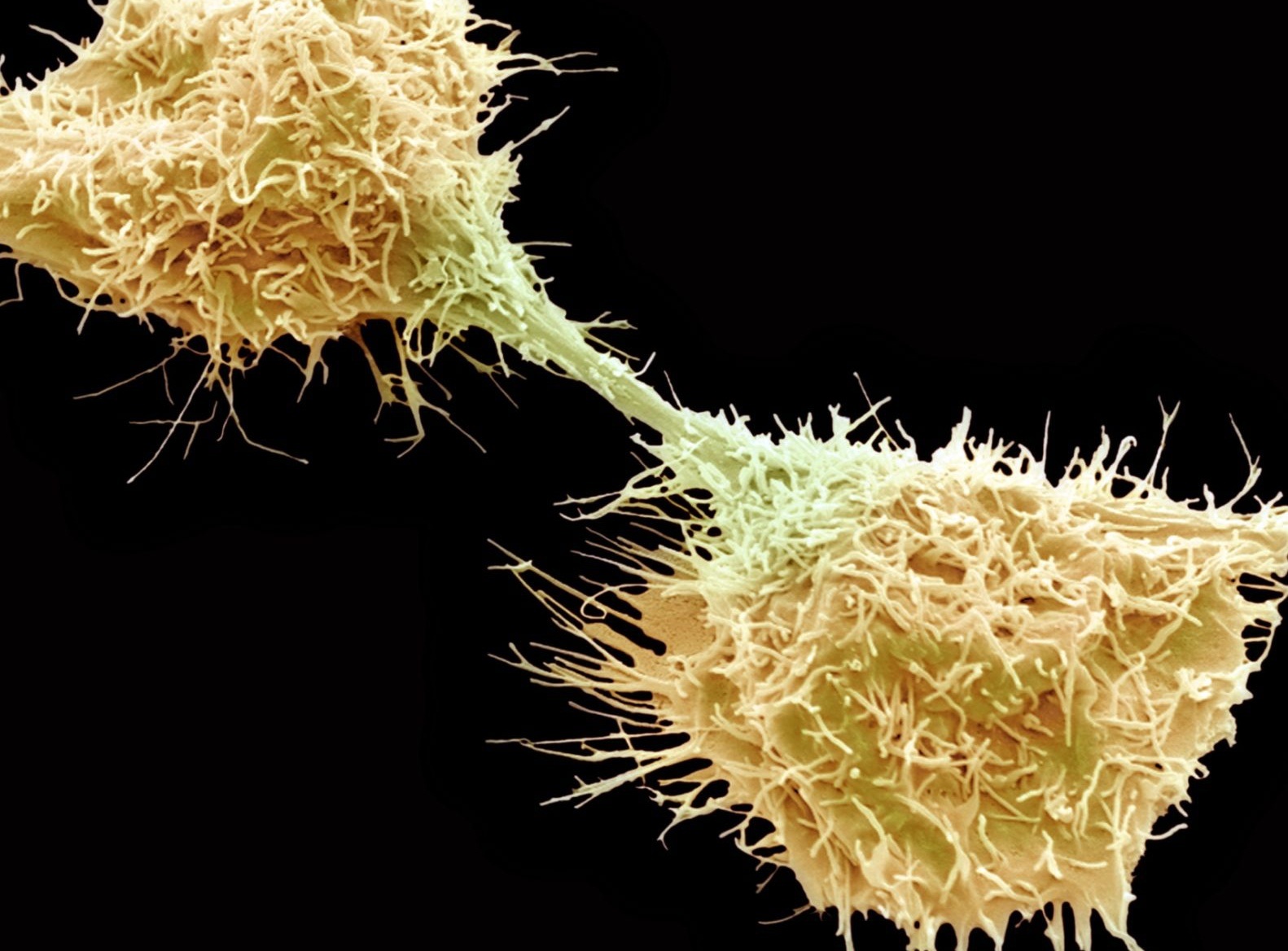 Triệu chứng của ung thư m&ocirc; li&ecirc;n kết - 1