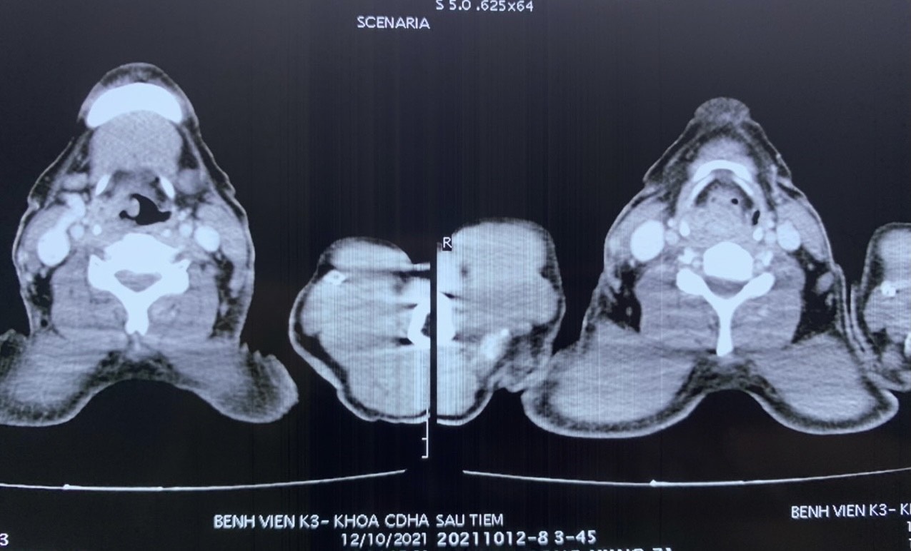 Sau 2 tháng khản tiếng, ho nhiều, người đàn ông phát hiện ung thư hạ họng - 1 Sau 2 tháng khản tiếng, ho nhiều, người đàn ông phát hiện ung thư hạ họng - 1