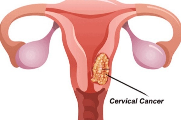Không quan hệ tình dục, một người liệu có mắc ung thư cổ tử cung? - 1
