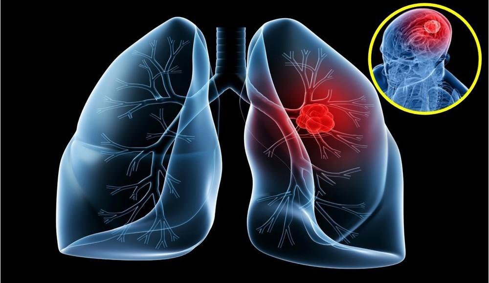 Vai trò của liệu pháp miễn dịch trong điều trị ung thư phổi - 1
