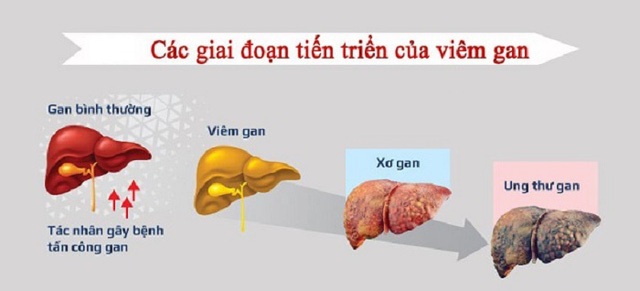 Những dấu hiệu cảnh báo ung thư gan giai đoạn đầu - 2