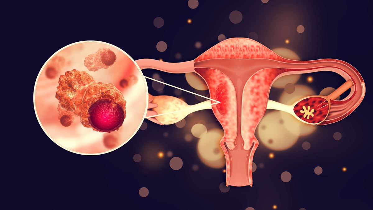Chứng rối loạn phổ biến ở phụ nữ có thể dẫn đến ung thư buồng trứng - 1