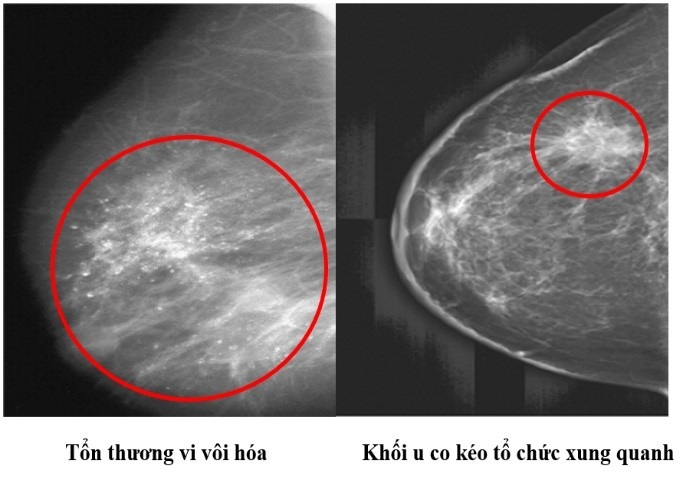 Ý nghĩa của các phương pháp sàng lọc ung thư vú - 3