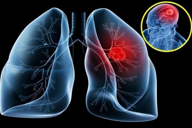 Phát hiện ung thư phổi lẩn trốn trong cơ thể như thế nào? - 1