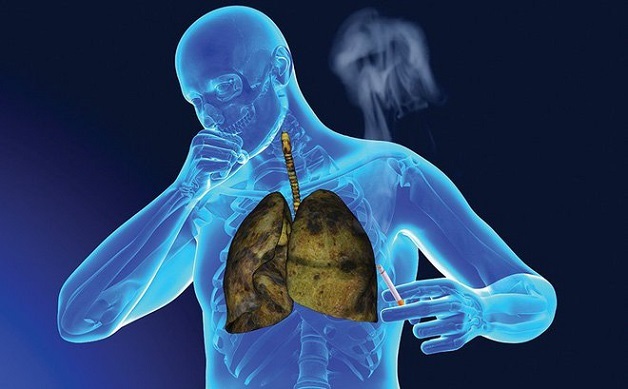Các yếu tố nguy cơ dẫn đến ung thư phổi không tế bào nhỏ - 1