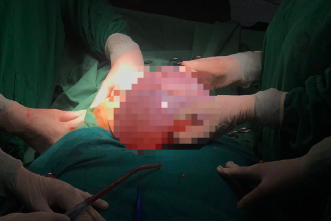 Vào viện vì đau bụng, người phụ nữ phát hiện khối u to như quả bóng - 1