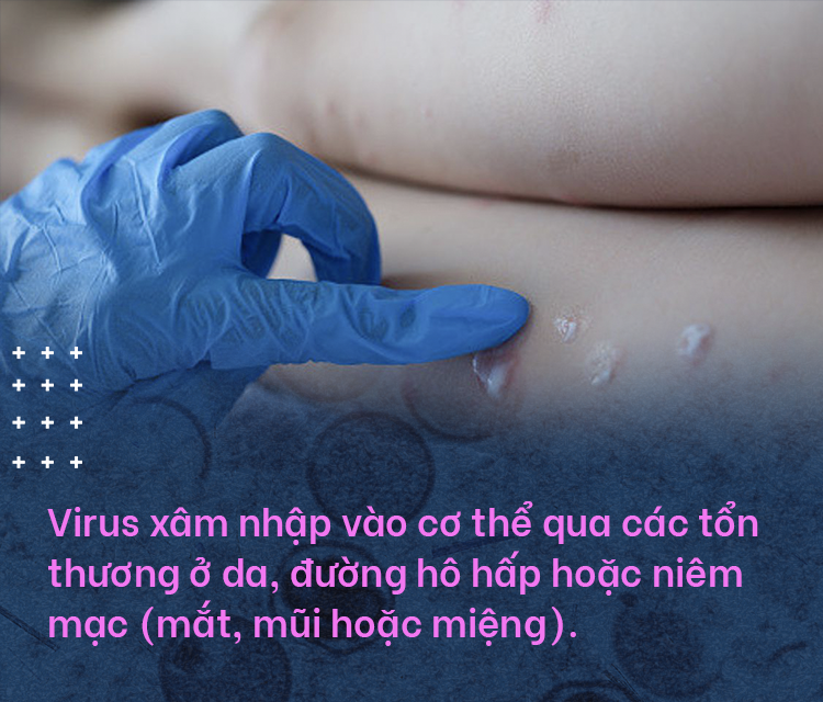 Đậu mùa khỉ: Vì sao căn bệnh bị xóa sổ 40 năm trước khiến WHO họp khẩn?