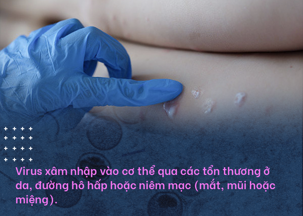 Đậu mùa khỉ: Vì sao căn bệnh bị xóa sổ 40 năm trước khiến WHO họp khẩn?