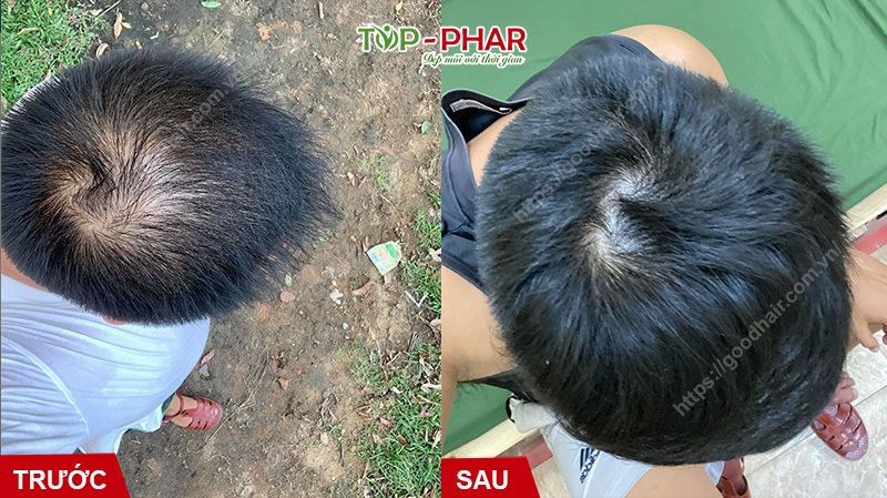 Goodhair DHT Blocker hỗ trợ kích thích mọc tóc cho người rụng tóc, hói đầu - 2 Goodhair DHT Blocker hỗ trợ kích thích mọc tóc cho người rụng tóc, hói đầu - 2