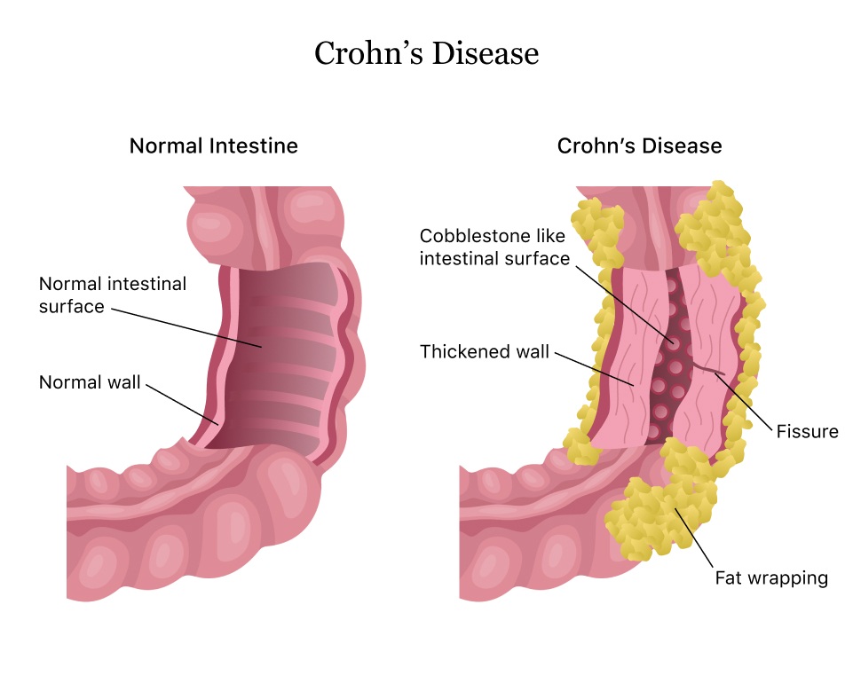 Bệnh Crohn có làm tăng nguy cơ ung thư không? - 1