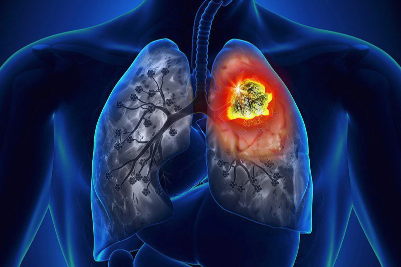 Chân xuất hiện 3 điểm bất thường này coi chừng ung thư phổi - 1