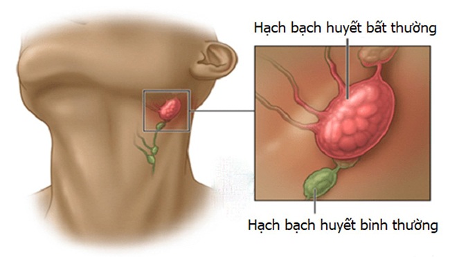 Nguyên nhân gây sưng hạch ở trẻ em - 1