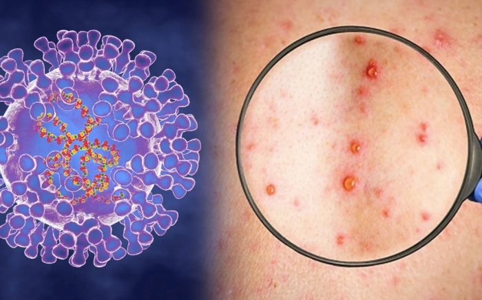 Phân biệt bệnh đậu mùa khỉ với thủy đậu, tay chân miệng - 1