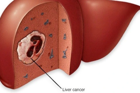 Nhận diện cơn đau trong ung thư gan