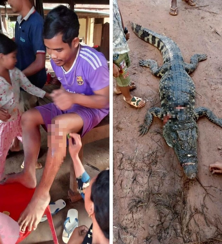 Choun Samnang với những vết thương trên chân do cá sấu cắn. Con vật đã bị dân làng giết chết sau đó (Ảnh: CBEO).