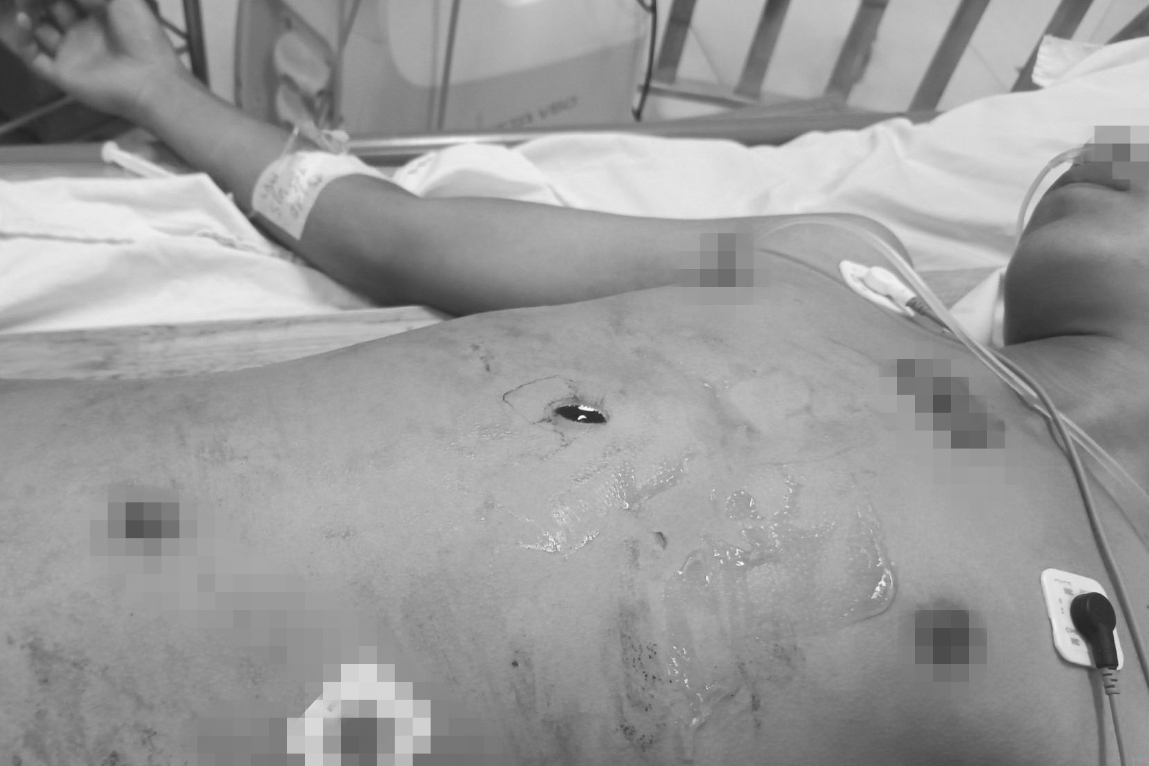 Thiếu niên 15 tuổi bị đâm dao xuyên từ bụng lên lồng ngực - Ảnh 1.