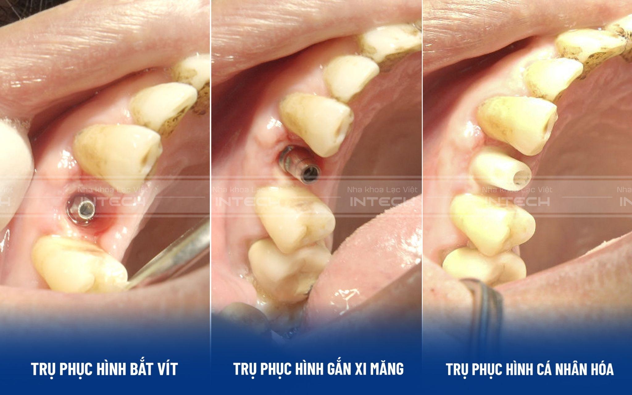 Công nghệ phục hình răng sứ trên implant DCT - 2